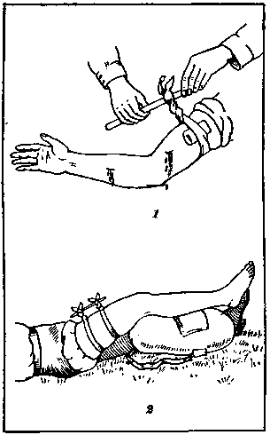 Остановка кровотечения: 1 — на руке, 2 — на ноге.